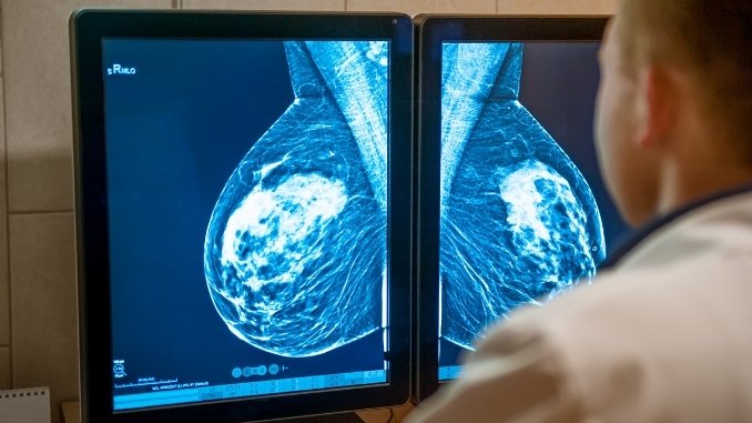 Black Women with early breast cancer had higher rates of obesity