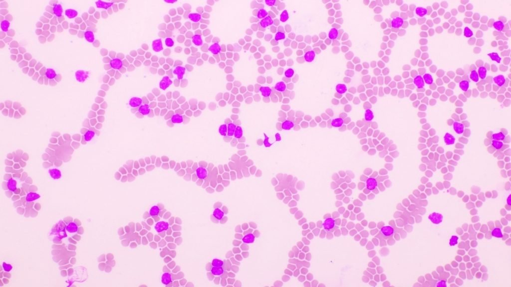Acute Myeloid Leukemia (AML): New drug combination shows powerful treatment for AML