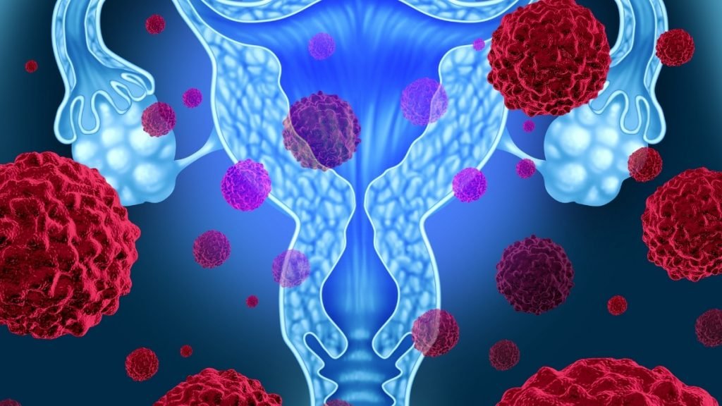 Study shows how women make choices about surgery to prevent ovarian cancer